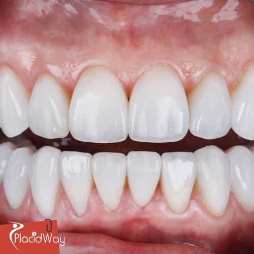 Veneers in Colombia: Affordable Cosmetic Dentistry for New Jersey Patients